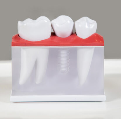 Everything You Need to Know Before Getting Dental Implants