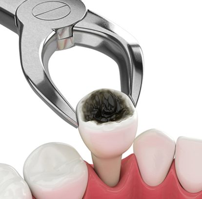 What Are the Most Common Reasons for Tooth Extractions?