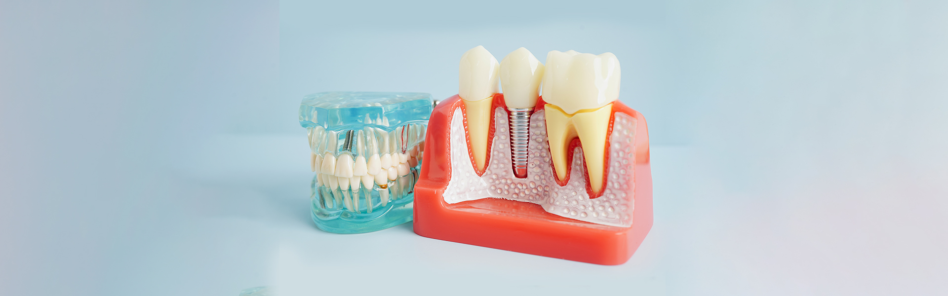 8 Benefits of Dental Implants You Should Know Before Choosing