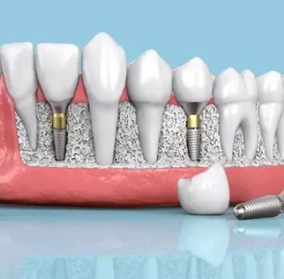 Why Choose a Local Implant Dentist in Newnan, GA?