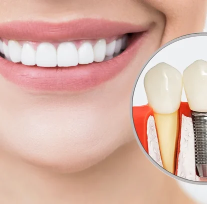 Smoking and Dental Implants: Risks Explained