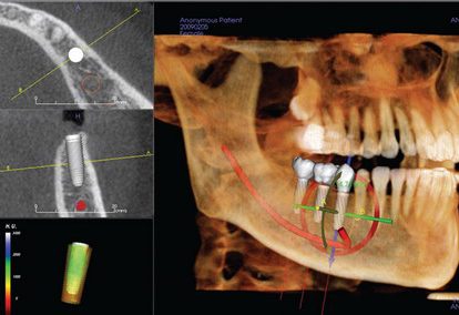 CBCT scan used to plan dental implant position near important jaw anatomy