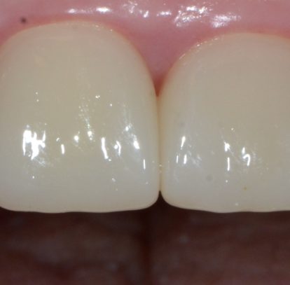 After treatment showing crowns on teeth 8 and 9 and veneers on teeth 7 and 10