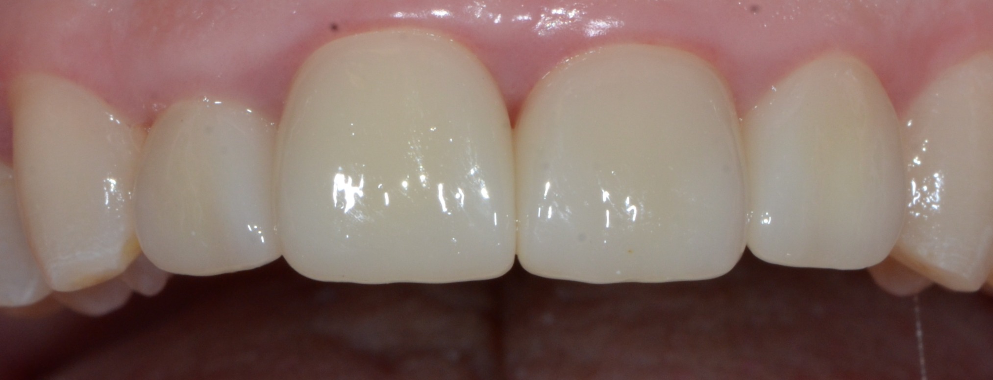 After treatment showing crowns on teeth 8 and 9 and veneers on teeth 7 and 10