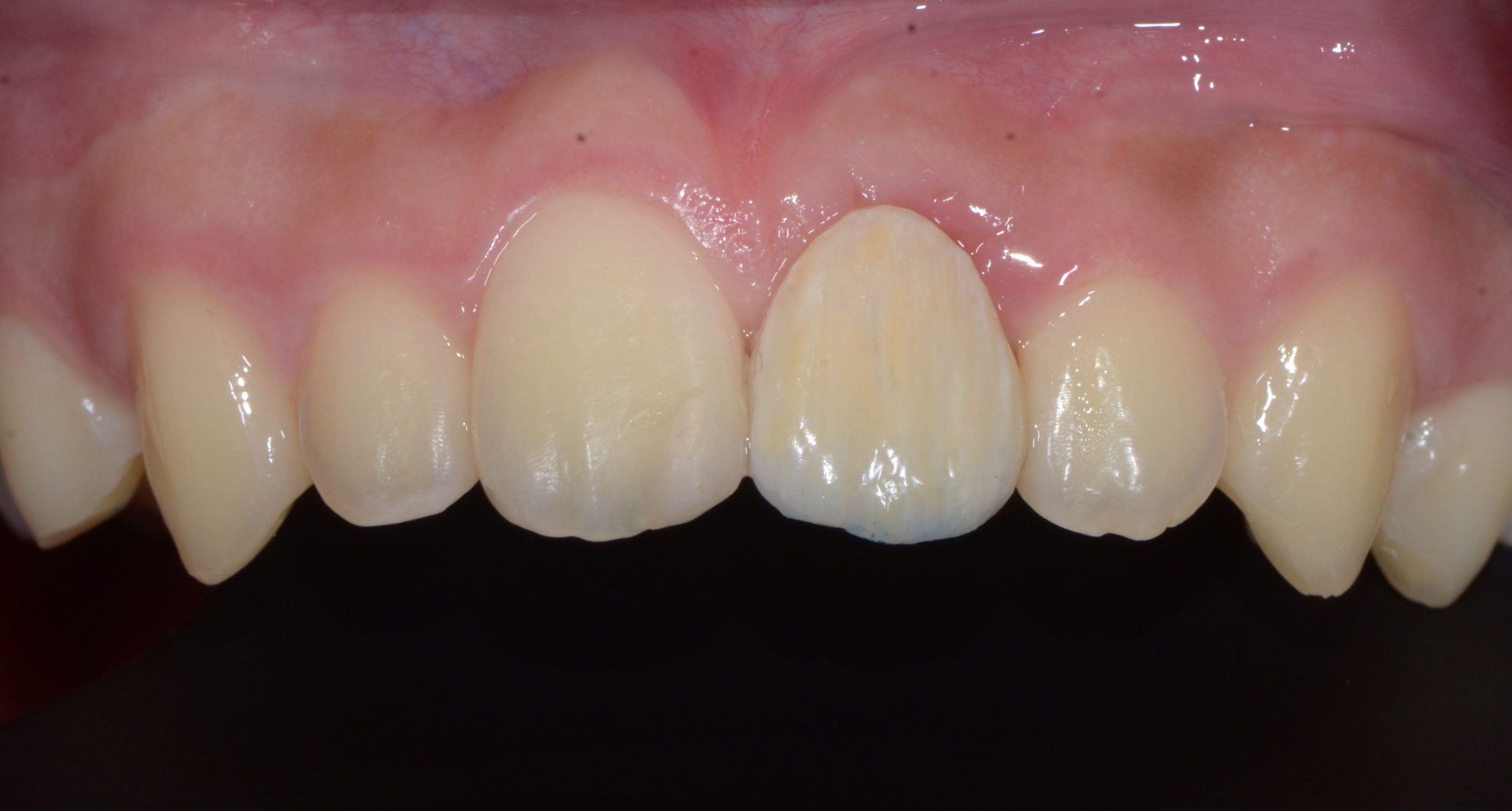 After treatment: restored front tooth with a conservative Maryland bridge