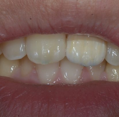 Conservative Front-Tooth Replacement After a Skateboarding Accident