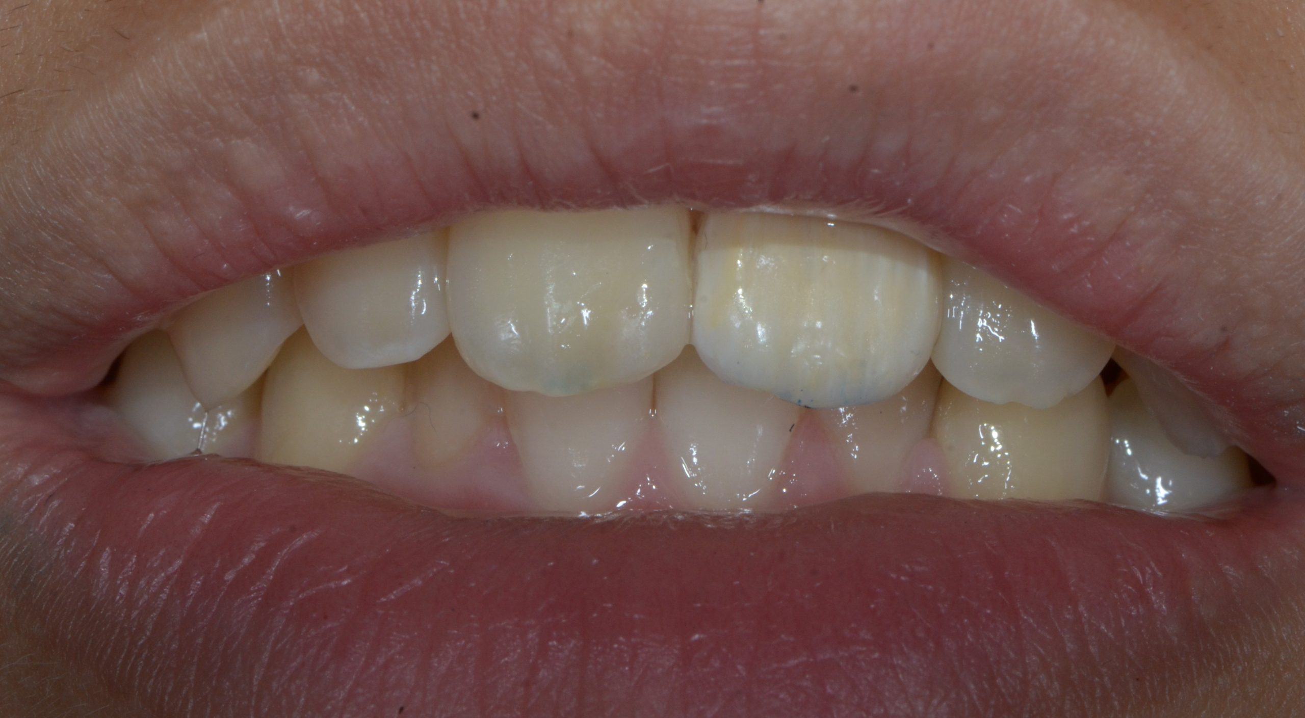 Patient smile after conservative front-tooth replacement
