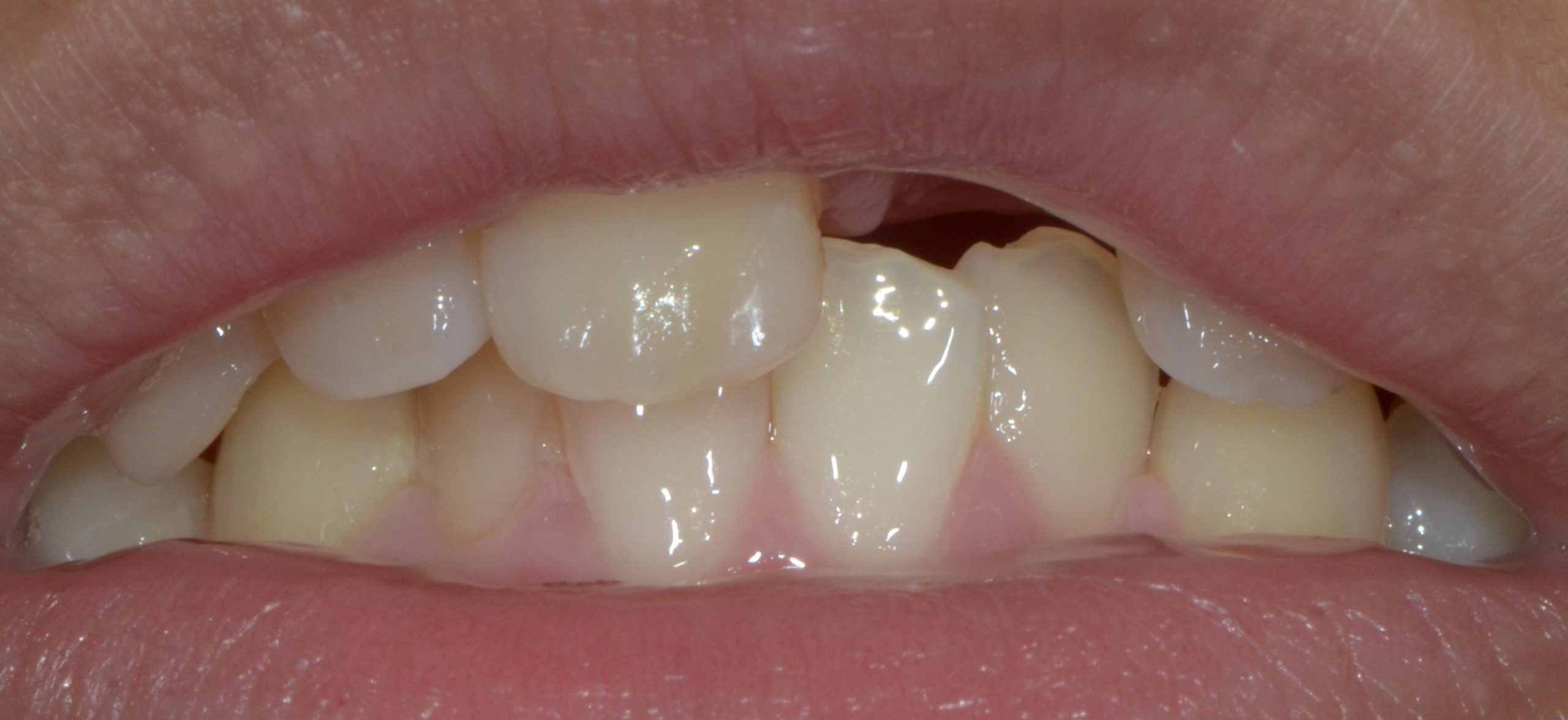 Patient smile before front-tooth replacement