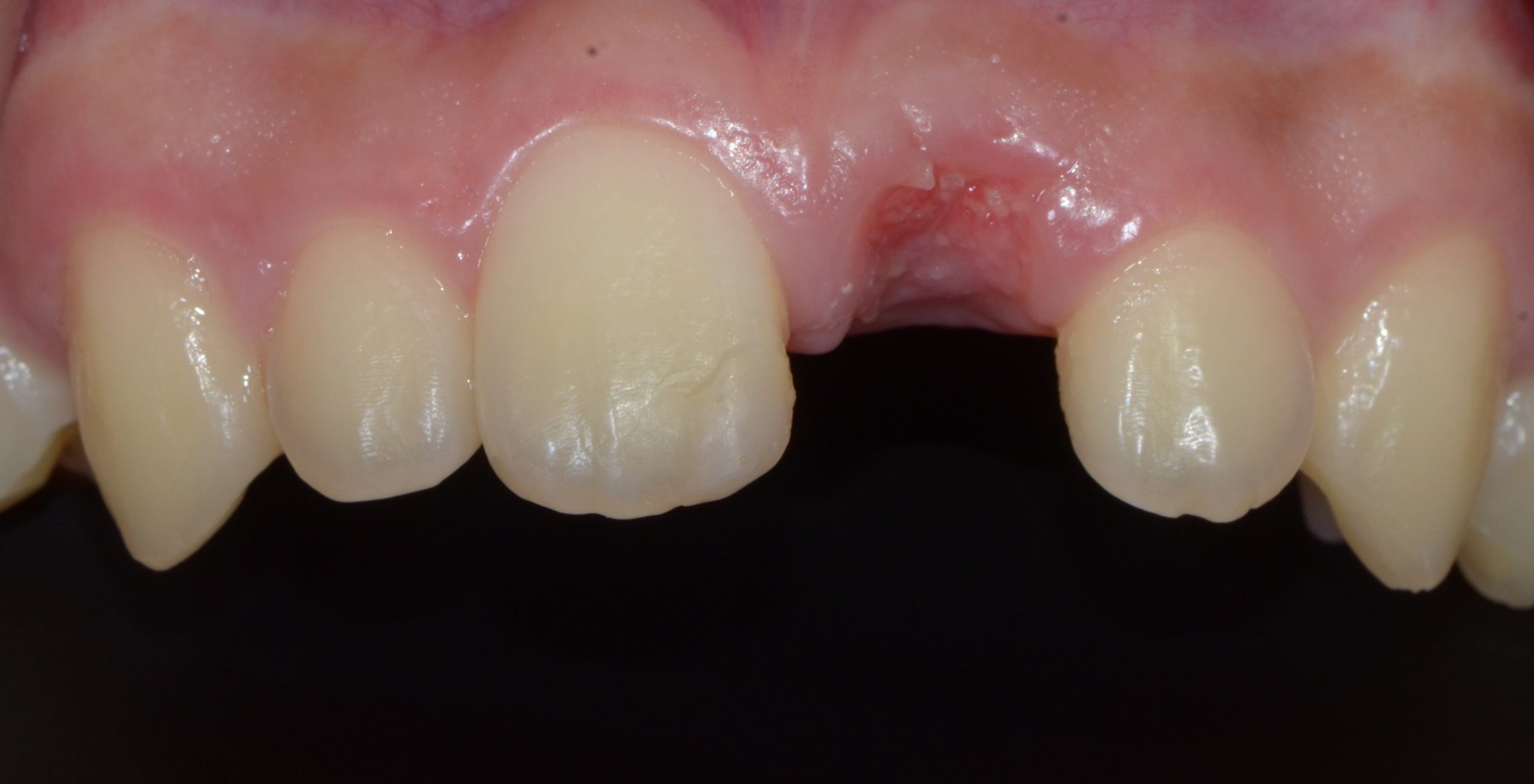 Before treatment: front-tooth space after a skateboarding accident